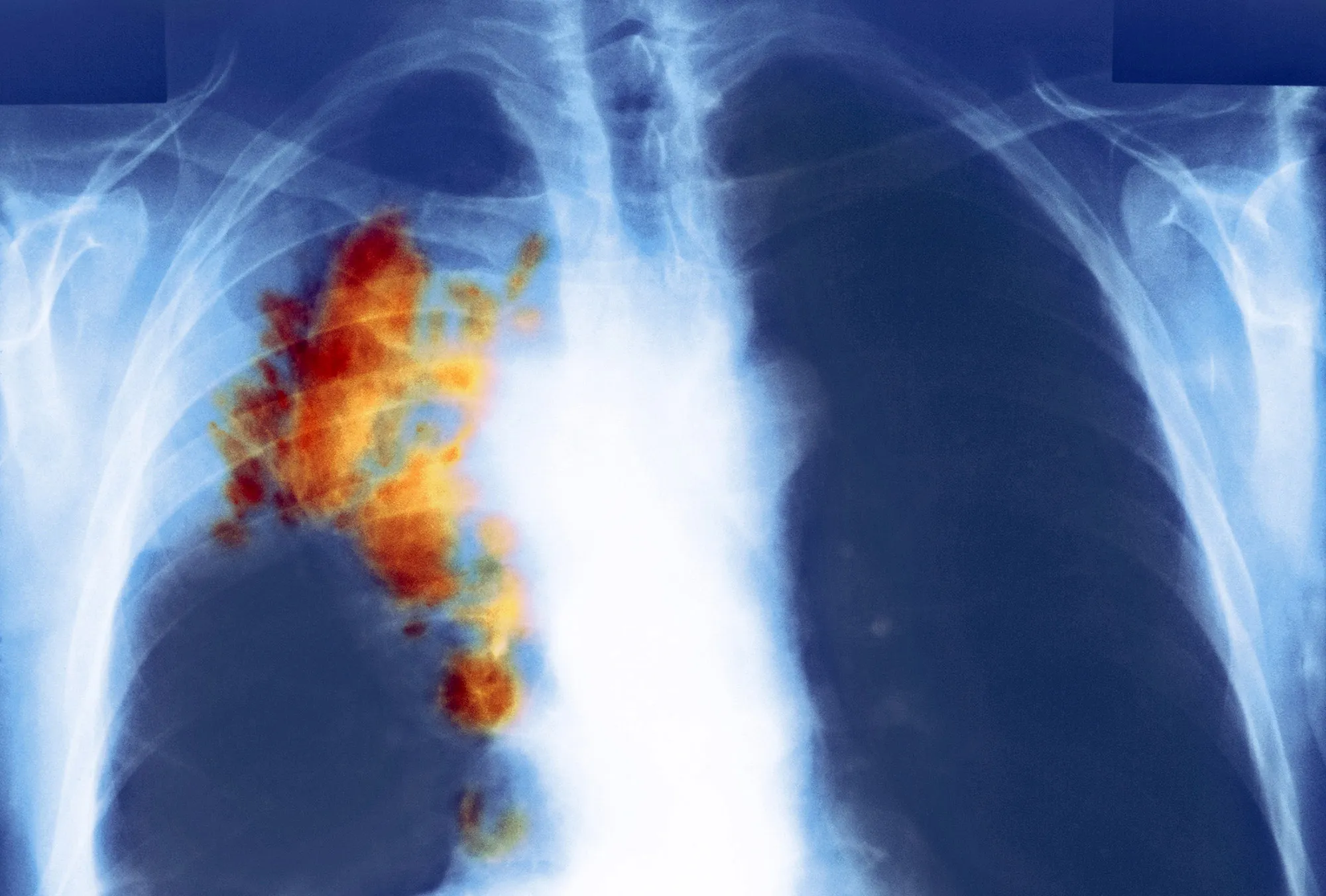 The chest of a patient with small cell lung cancer.