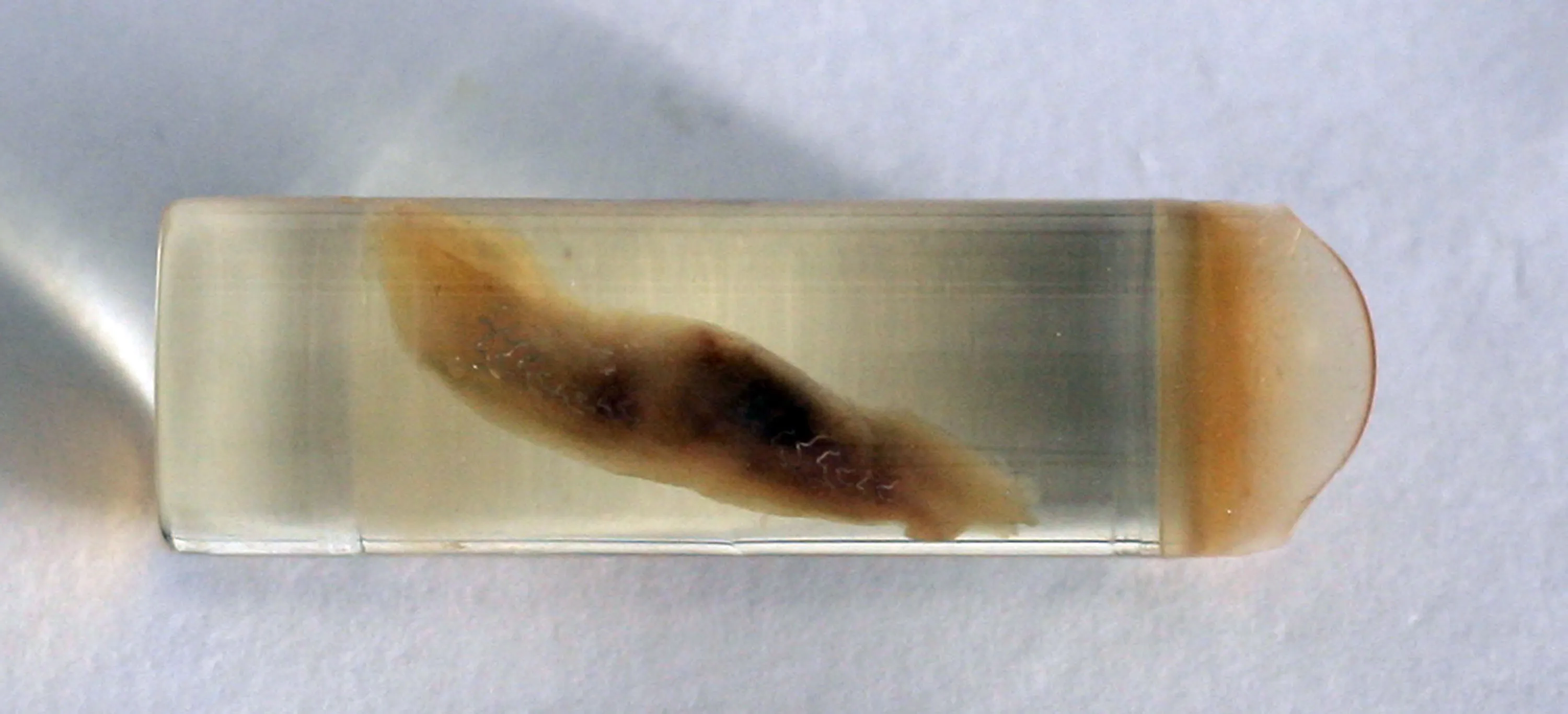 A coronary vessel with a stent