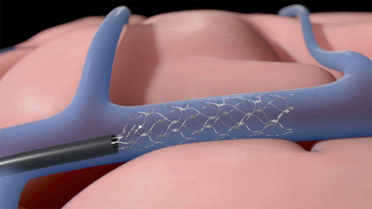 The Stentrode brain-computer interface, implanted via procedures commonly used for neurovascular stent implantation, is designed to self-expand and grow into the blood vessels wall without obstructing blood flow.