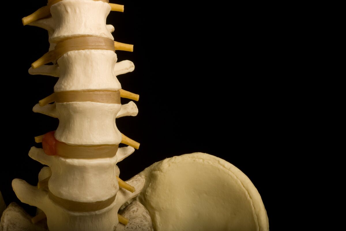 Carlsmed Plans $100M Nasdaq IPO for AI Spine Surgery