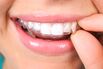 RF dental Invisalign