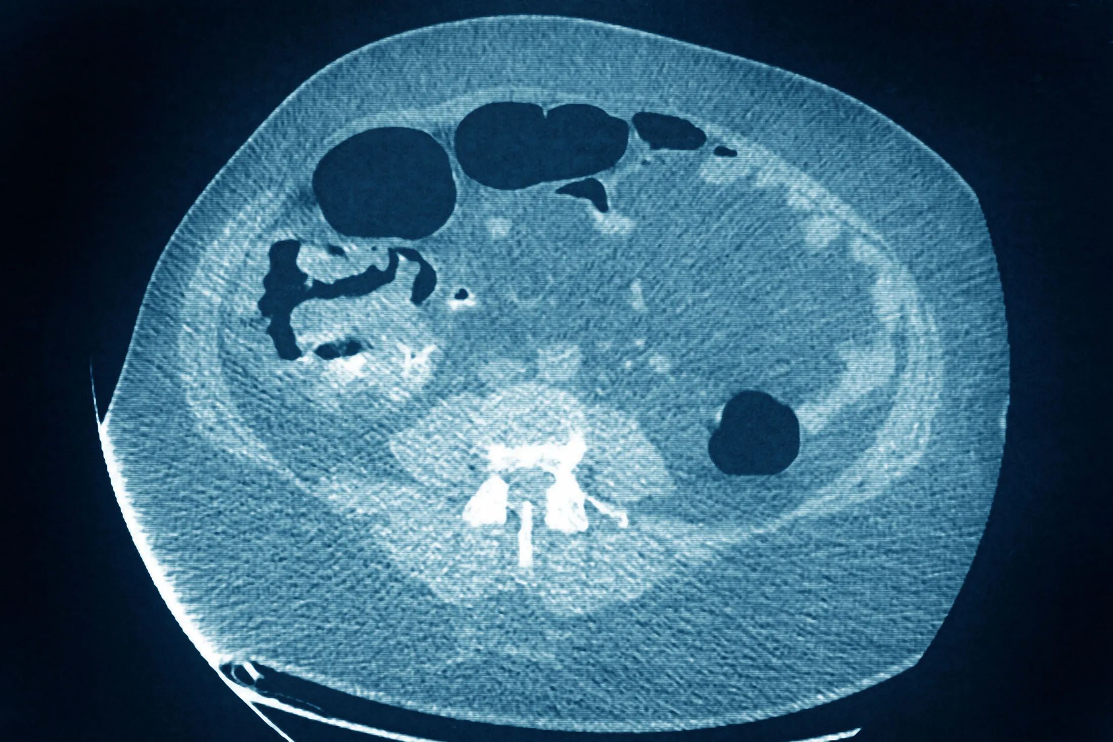 A colon cancer tumor seen on a radial CT scan.