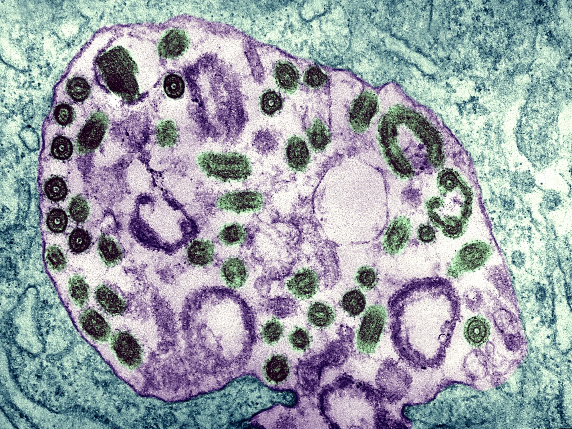 Marburg Disease Outbreak: Global Spread Risk Near Zero on Quick Rwanda ...