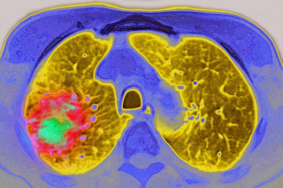 Amgen, Astra Drug Duo Boosts Survival for Deadly Lung Cancer