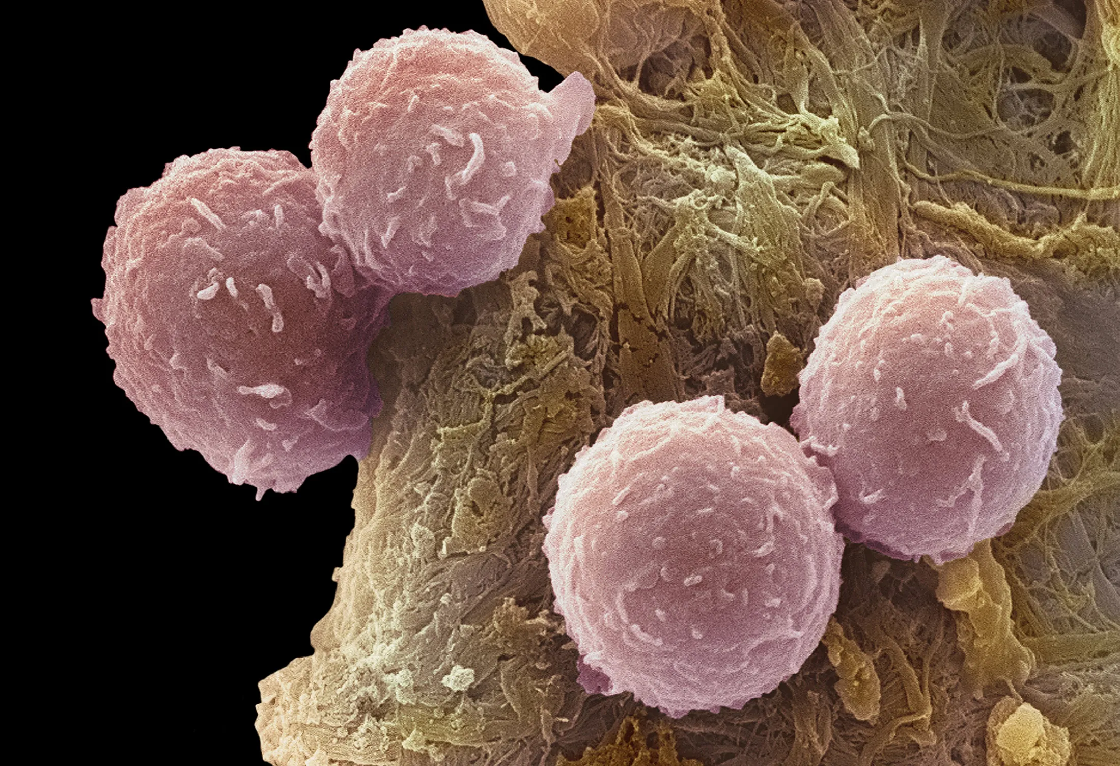 Leukaemia blood cells.