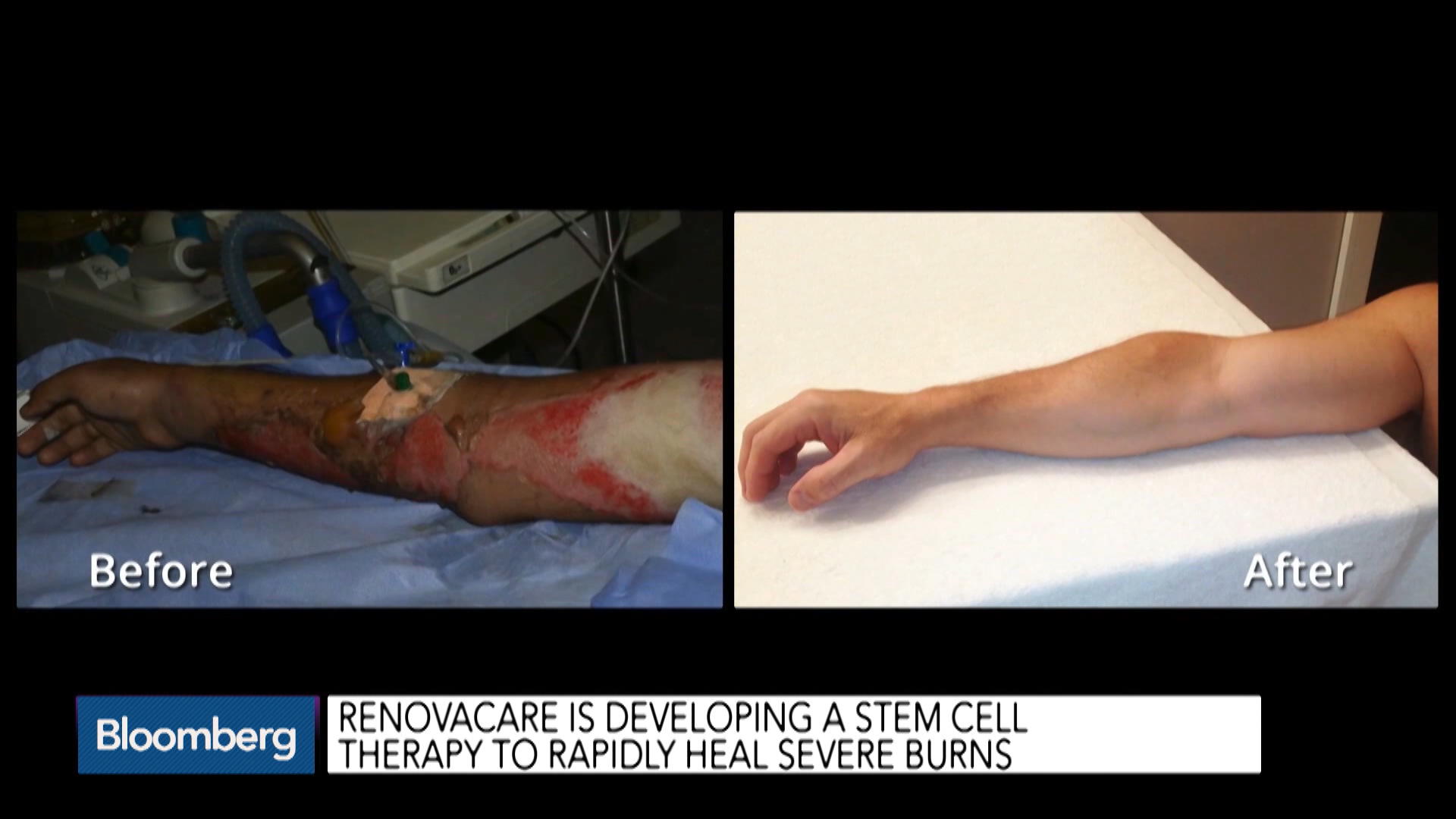 severe burn victims healed