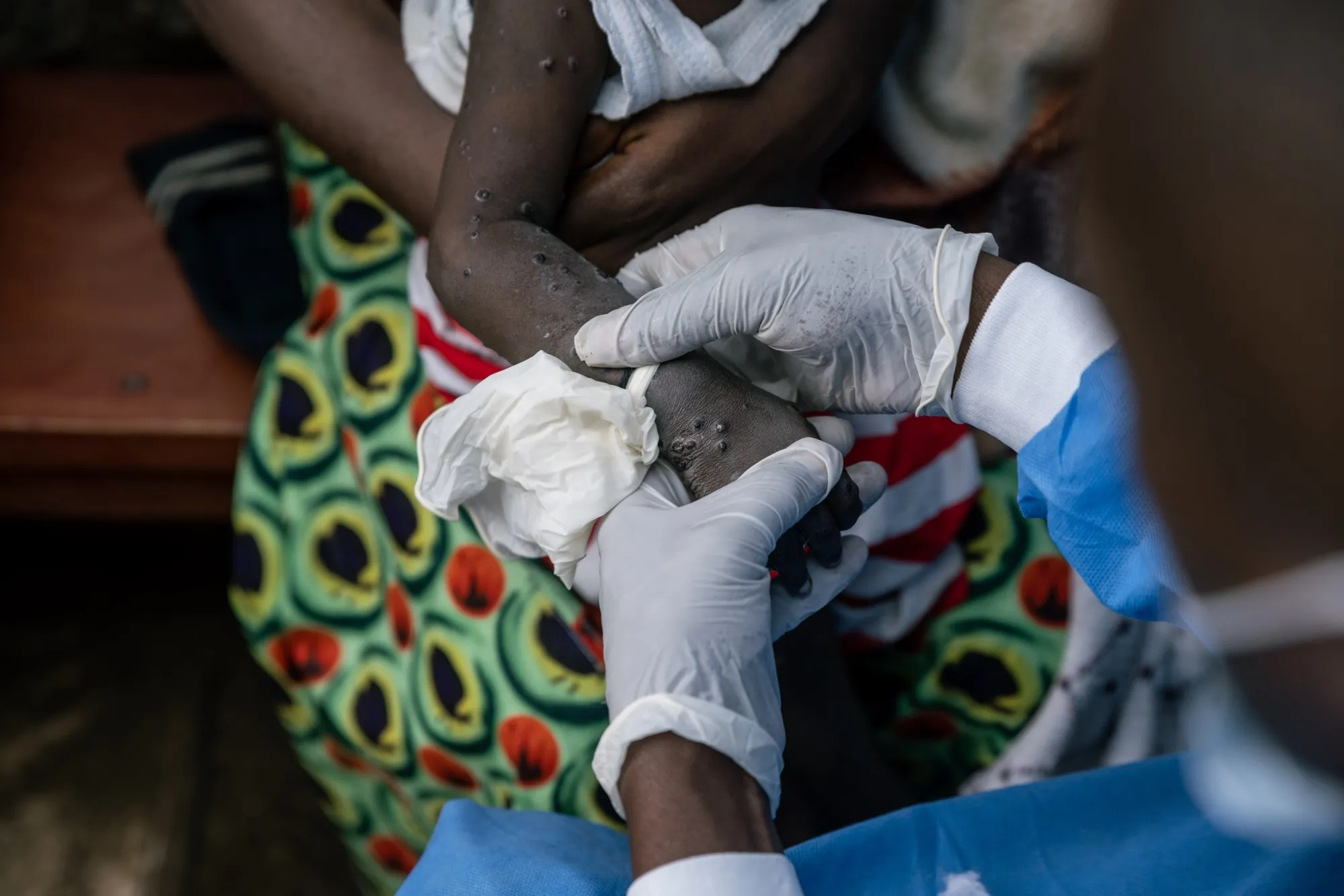 A nurse treats a young child with mpox at the Kavumu hospital in Kabare territory, Democratic Republic of Congo, on&nbsp;Sept. 3.