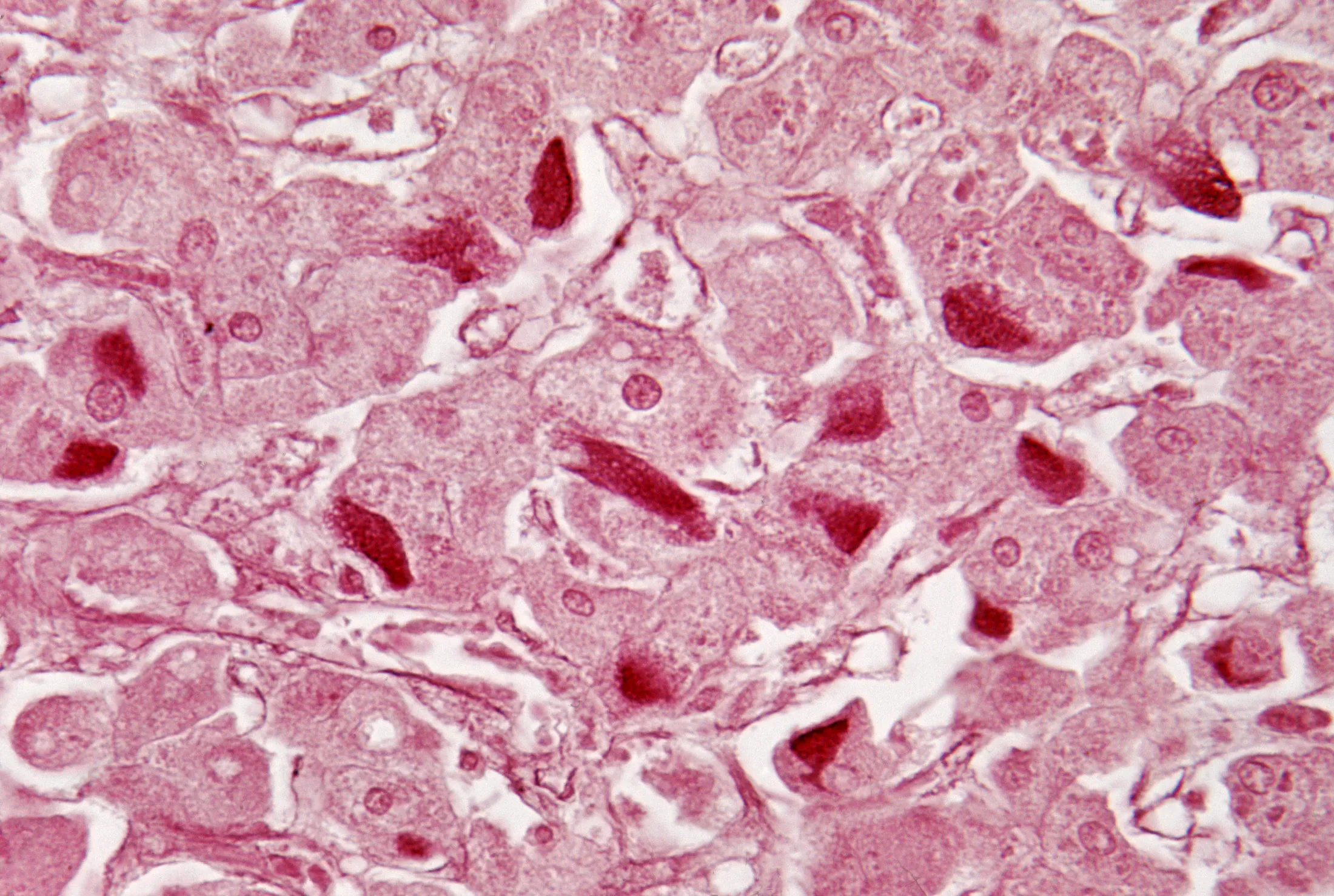 Human liver with viral hepatitis.

