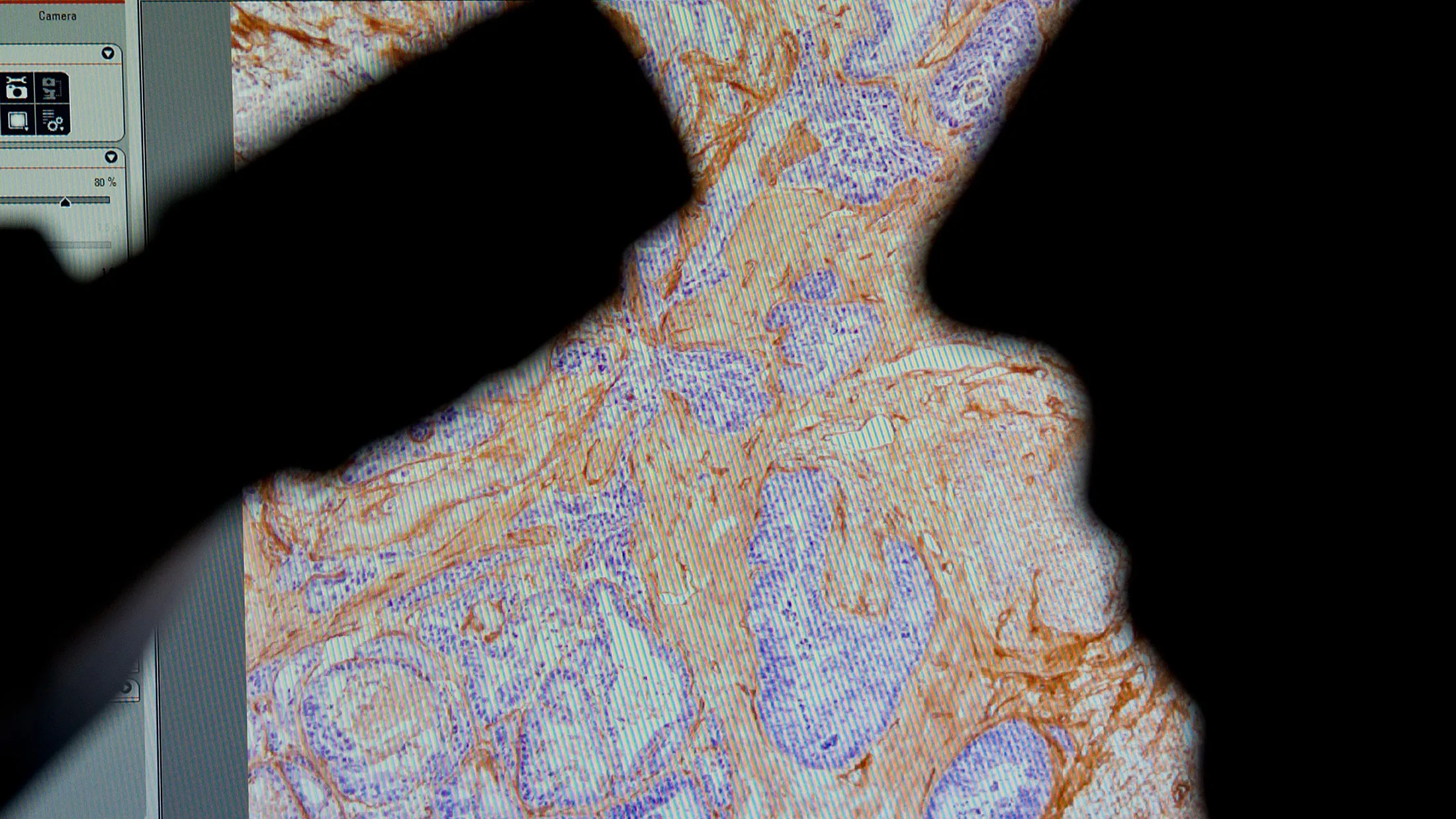 A researcher looks at a slide of a human colon cancer tumor.
