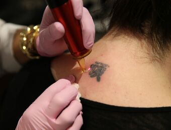 relates to No Pain No Gain as Tattoo Regret Fueling Laser Removals