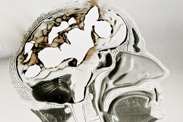 Alzheimer's: The Costliest Killer