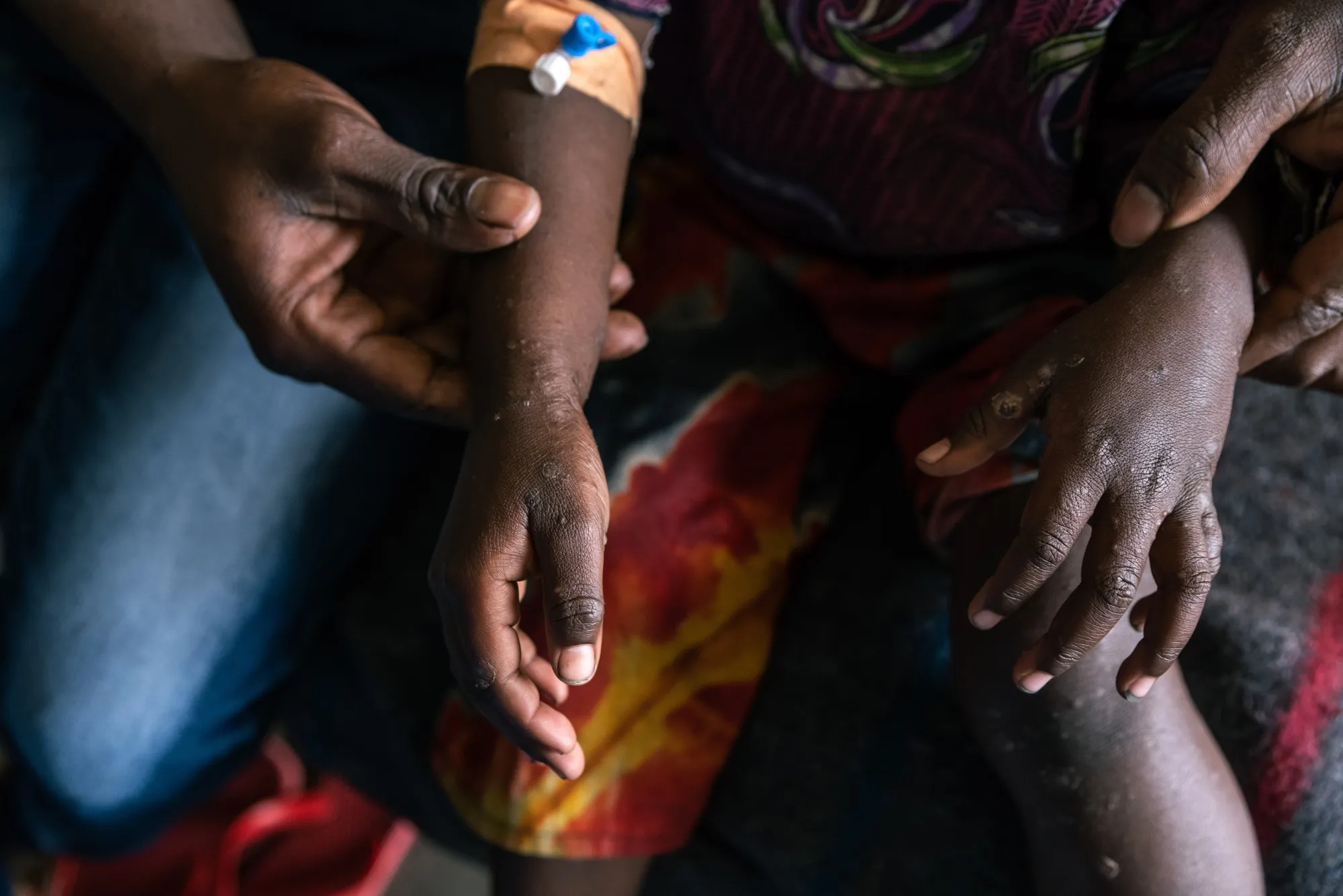 Last week, the current head of the Africa CDC, Jean Kaseya, said mpox cases were suspected in at least 15 African nations. 