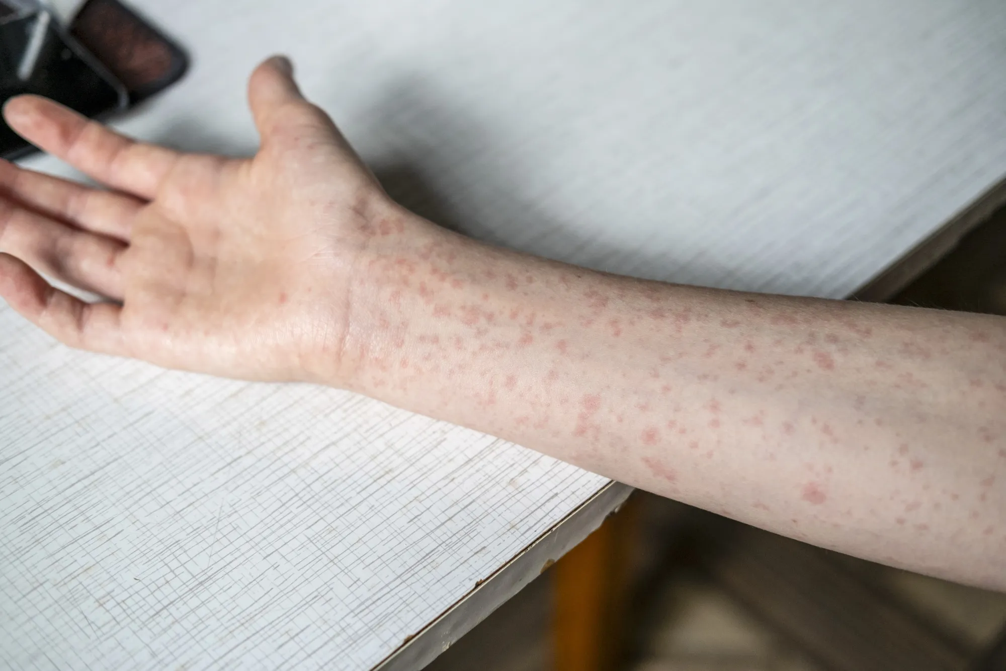 A person infected with measles displays a rash.