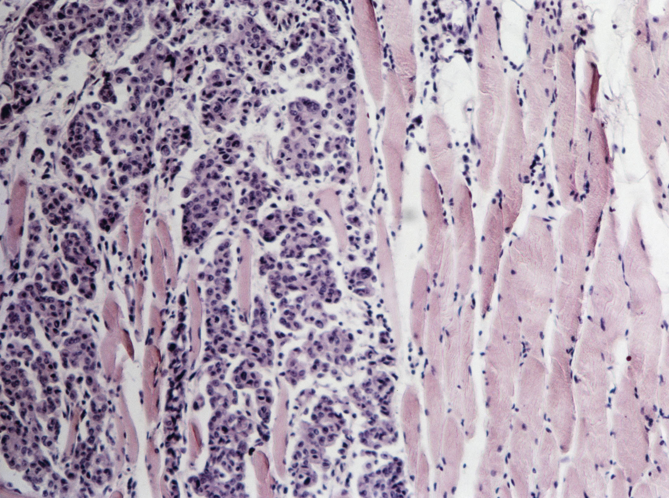 Carcinoma invading a human striated muscle.