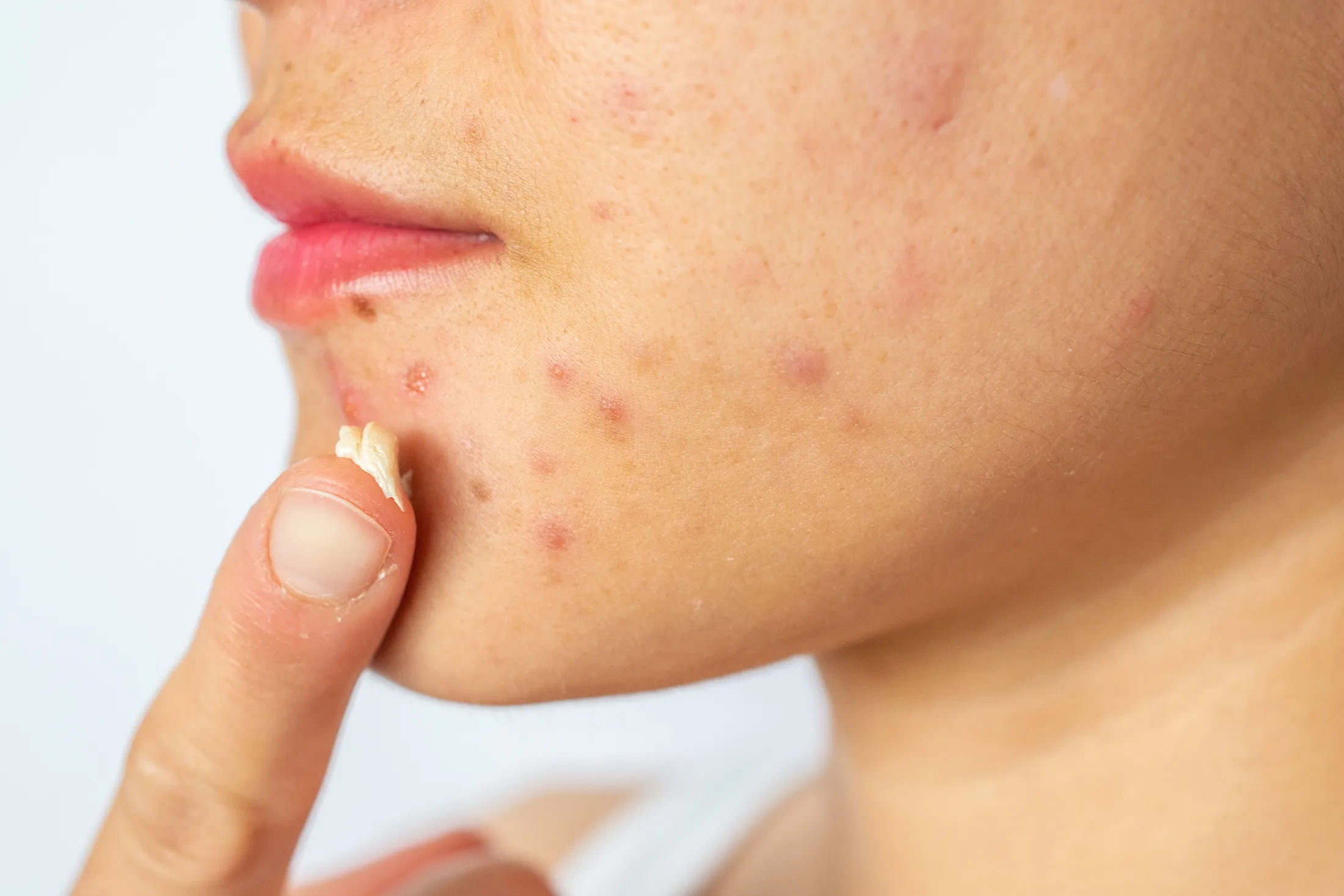 Woman applying acne cream on her face for solving acne inflammation (Papule and Pustule) on her face RF