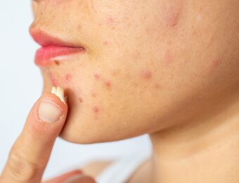 relates to Doctors Urge Refrigerating Acne Creams to Reduce Cancer Risk