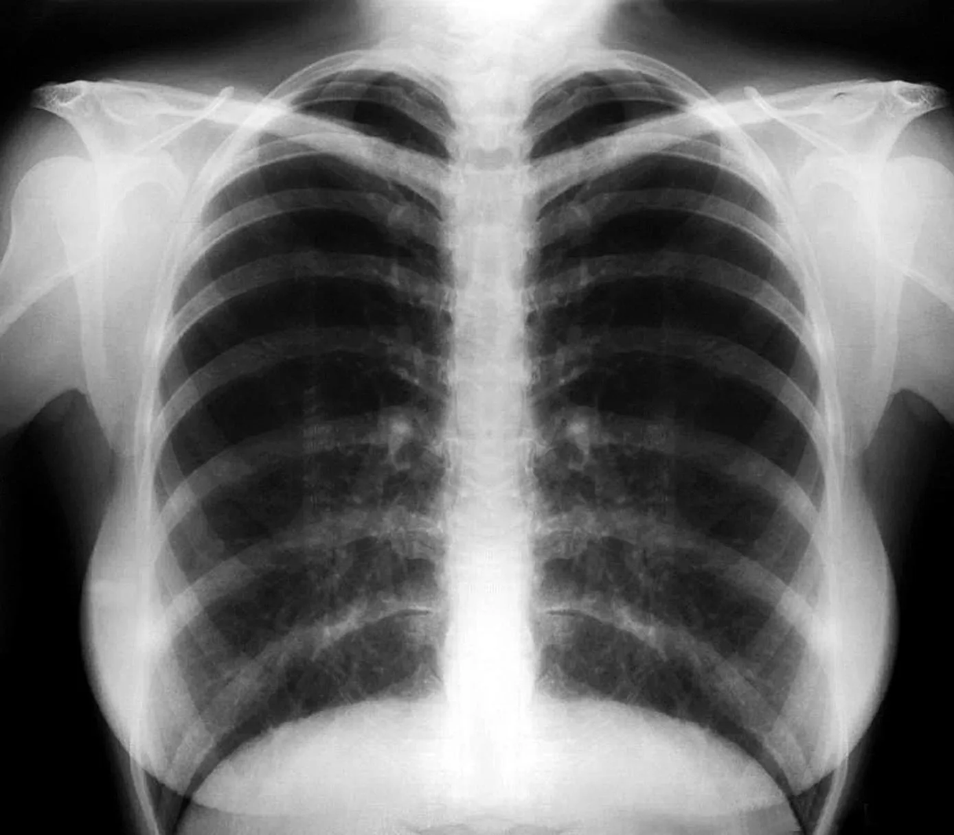 black lung. Source: The Construction, Forestry, Mining and Energy Union
