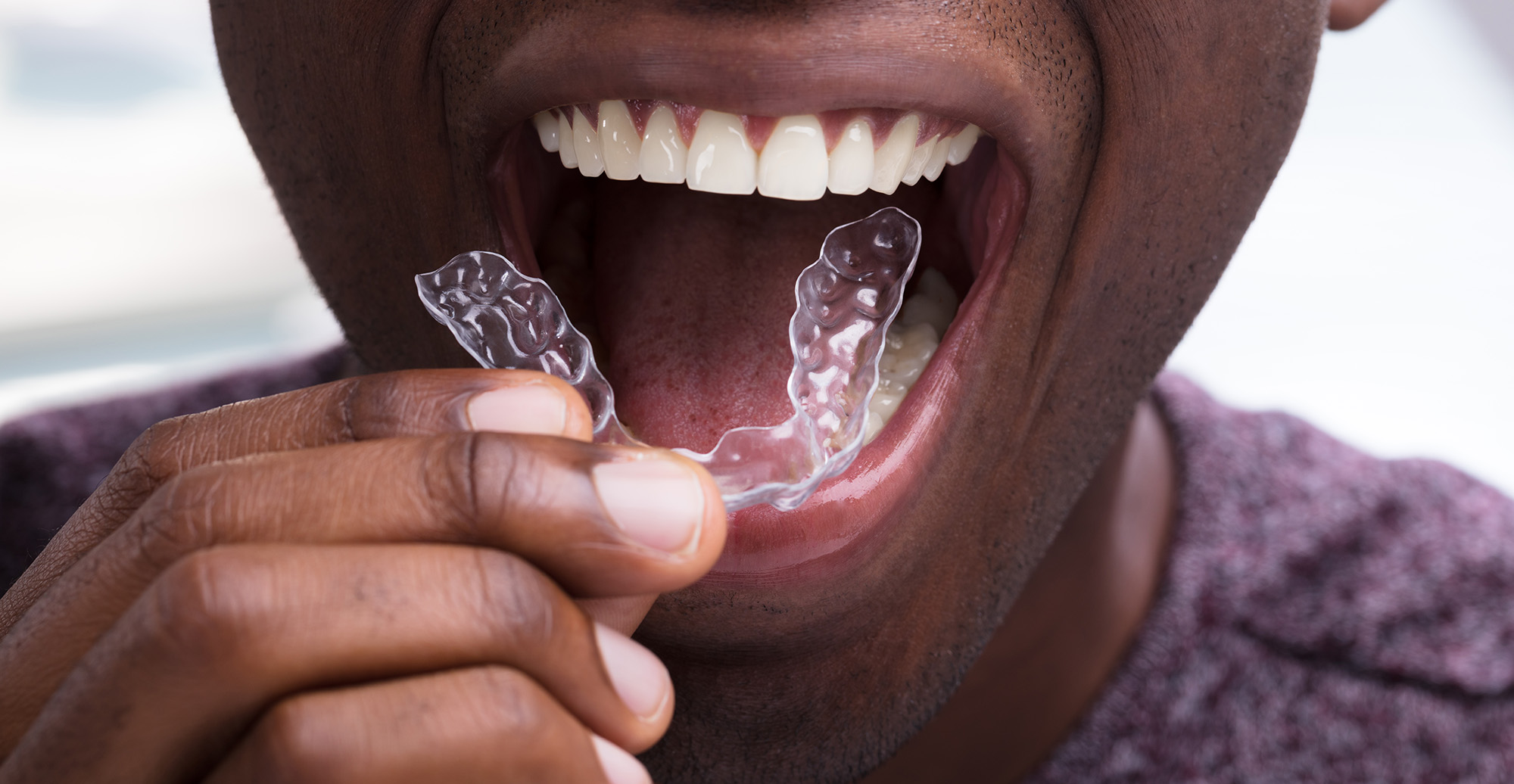 ALGN Stock Surges As Invisalign-Maker Sets Up A 'Show Me Story' For 2024