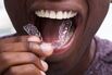 RF Invisalign dental 