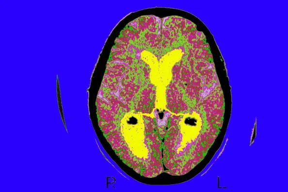 AlzheimerS Disease, Scan