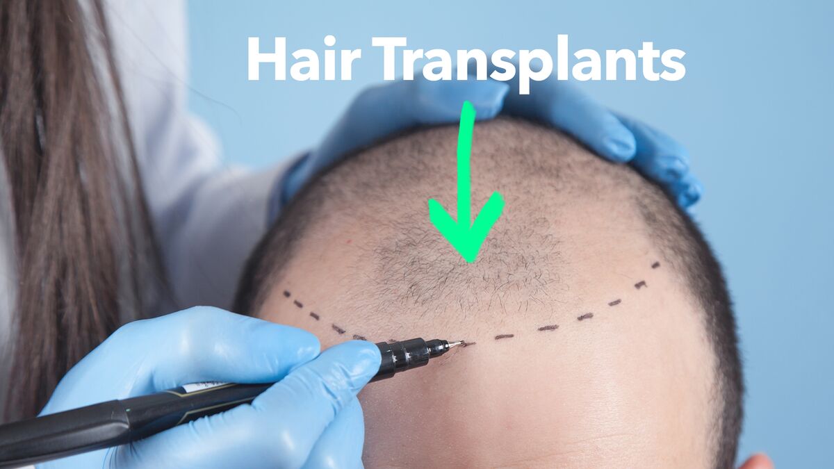 How Hair Transplants in Istanbul Become Popular Option Among Men Worldwide  - Bloomberg
