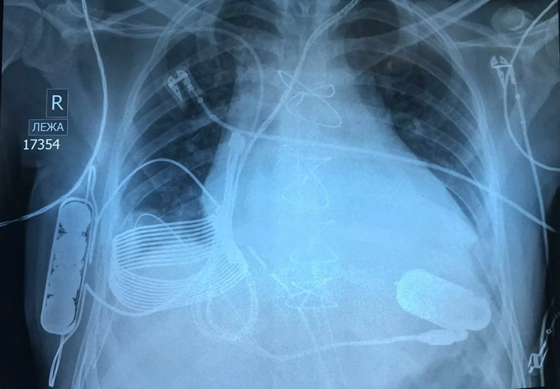 X-ray showing the mechanical heart pump.
