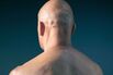 Diagnosing Skin Cancer With Google Images