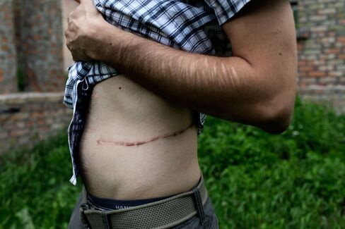 Renat Abdullin, shows the scar from his kidney surgery