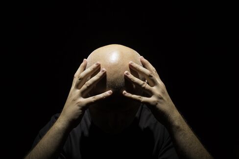 Male Baldness May Signal Increased Heart Disease Risk