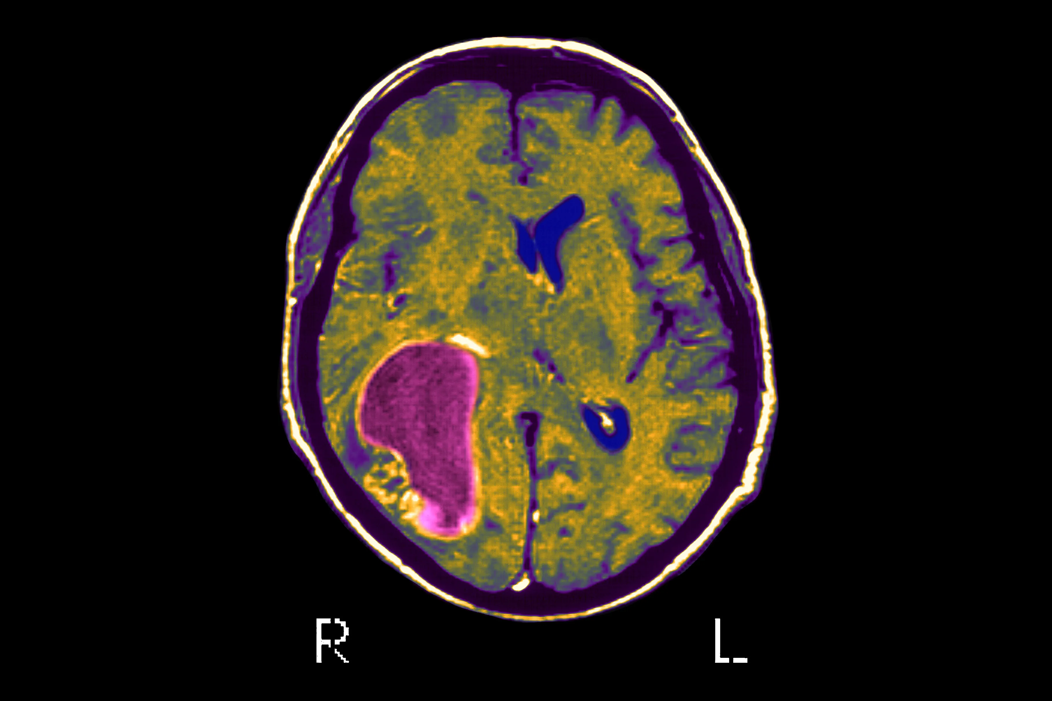 Glioblastoma
