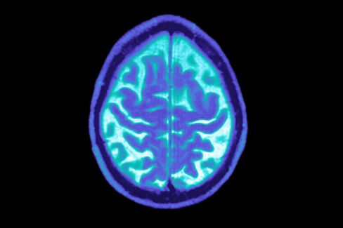 No Cure for Alzheimer’s Without Brain Donations