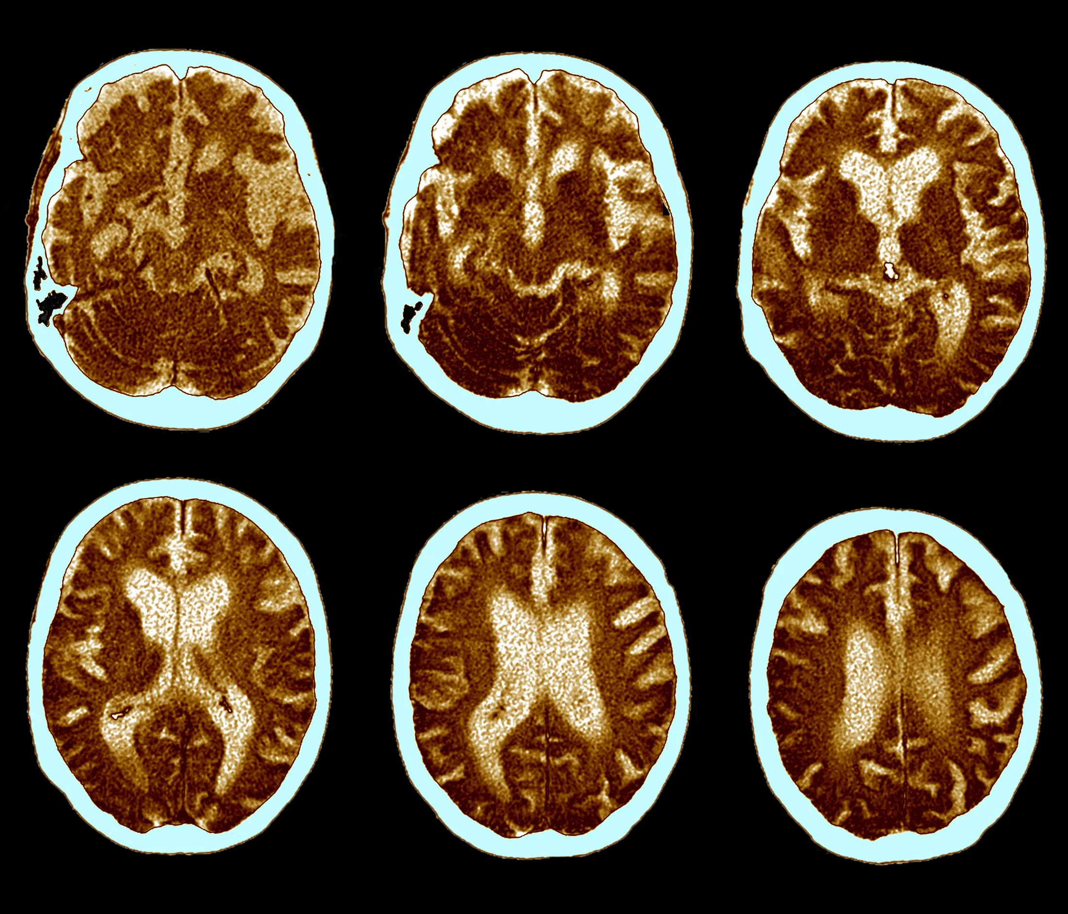 CAT scan of Alzheimer's disease.
