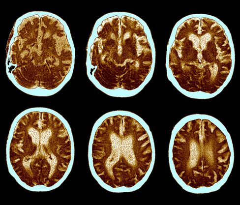 CAT scan of Alzheimer's disease.