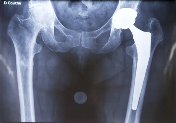 Hip replacement surgery was&nbsp;the best test case.