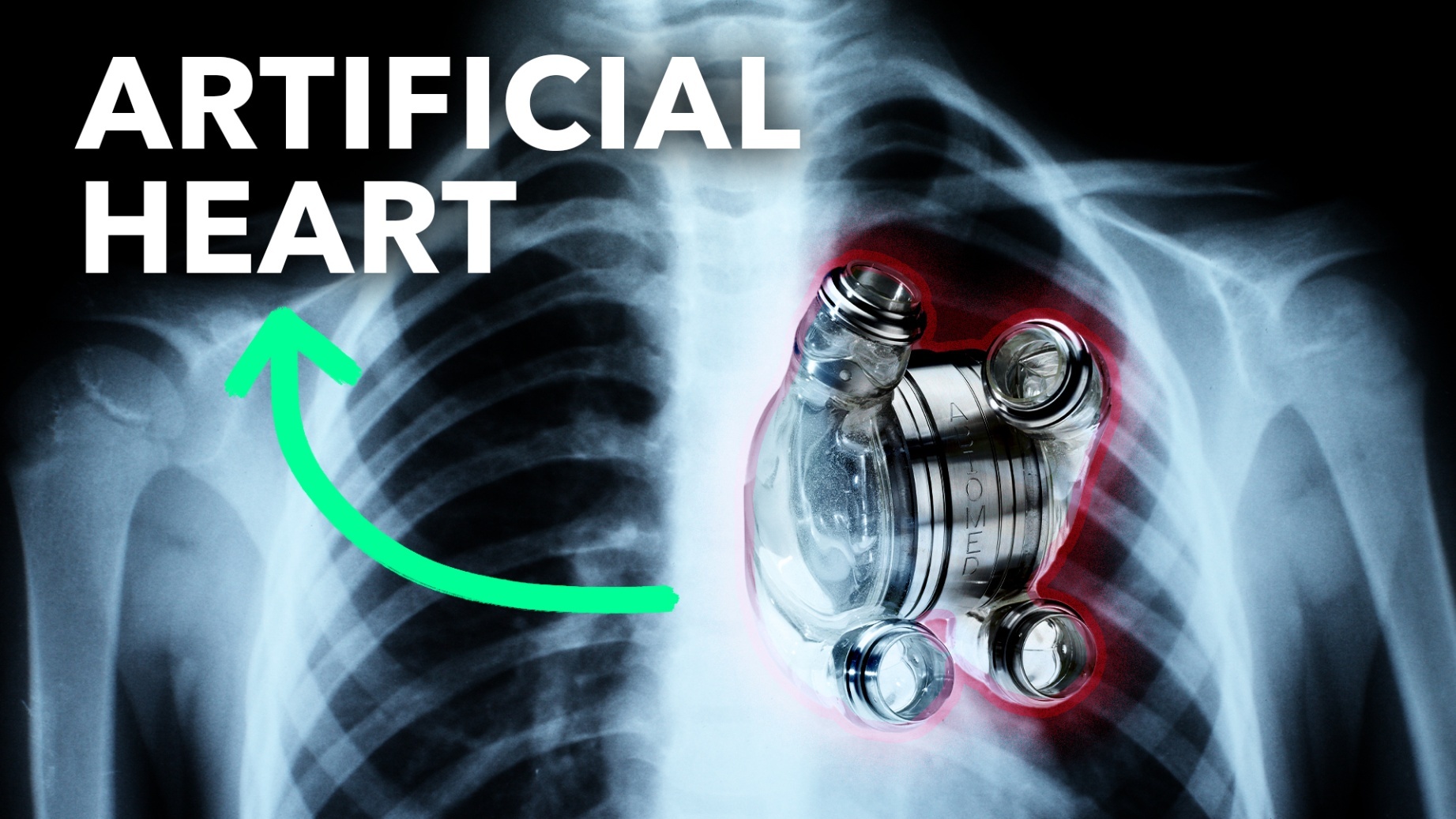 Watch Permanent Artificial Hearts Are Closer Than You Think Bloomberg