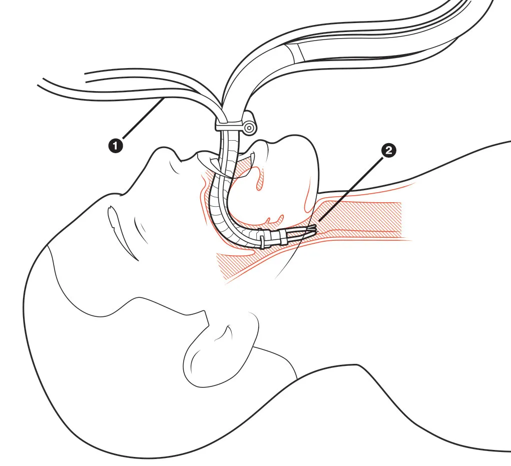 1. A surgeon inserts the robot into a patient’s mouth and maneuvers it into place using a joysticklike controller. 2. The surgeon uses hand controls to manipulate lasers, graspers, and other instruments attached to the robot, guiding them through the tubing to where they’re needed.

